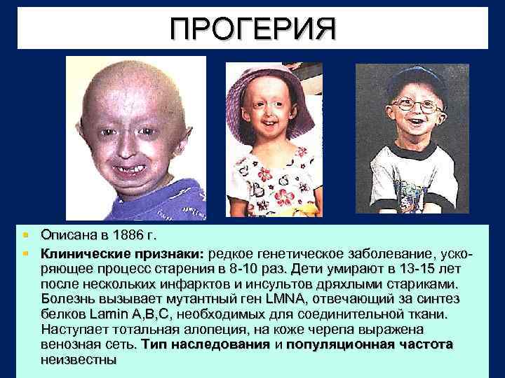 ПРОГЕРИЯ § Описана в 1886 г. § Клинические признаки: редкое генетическое заболевание, ускоряющее процесс