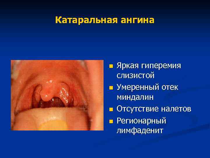 Катаральная ангина n n Яркая гиперемия слизистой Умеренный отек миндалин Отсутствие налетов Регионарный лимфаденит