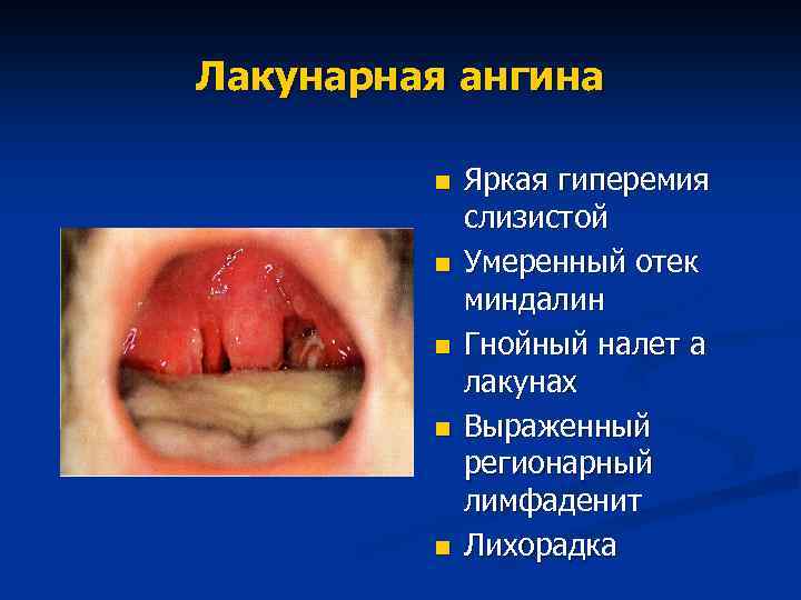 Лакунарная ангина n n n Яркая гиперемия слизистой Умеренный отек миндалин Гнойный налет а