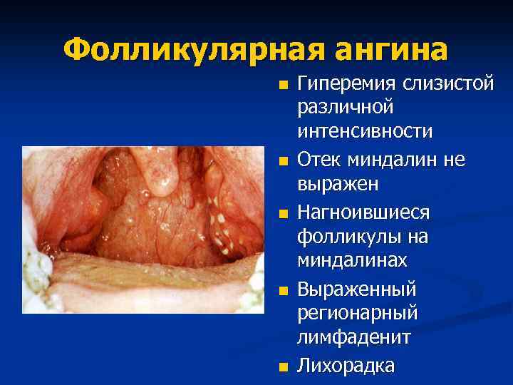 Фолликулярная ангина n n n Гиперемия слизистой различной интенсивности Отек миндалин не выражен Нагноившиеся