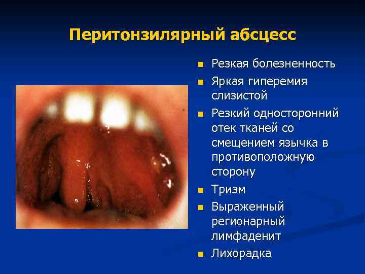 Перитонзилярный абсцесс n n n Резкая болезненность Яркая гиперемия слизистой Резкий односторонний отек тканей