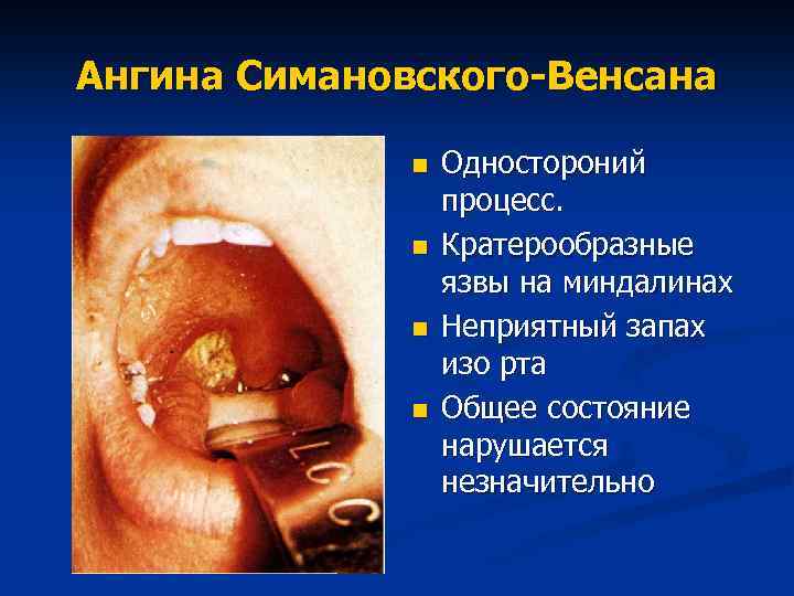 Ангина Симановского-Венсана n n Одностороний процесс. Кратерообразные язвы на миндалинах Неприятный запах изо рта