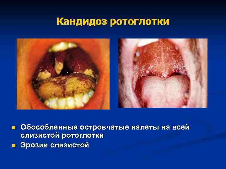 Кандидоз ротоглотки n n Обособленные островчатые налеты на всей слизистой ротоглотки Эрозии слизистой 