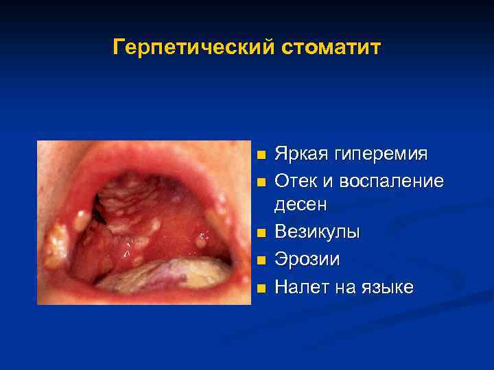 Герпетический стоматит n n n Яркая гиперемия Отек и воспаление десен Везикулы Эрозии Налет