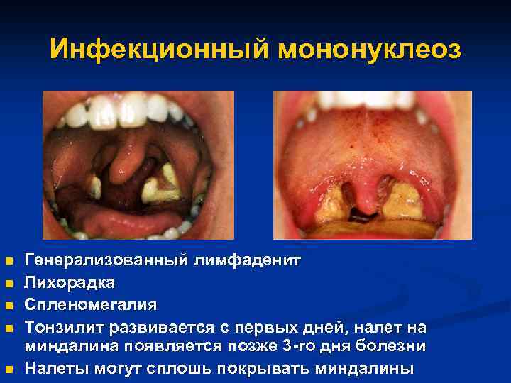 Инфекционный мононуклеоз n n n Генерализованный лимфаденит Лихорадка Спленомегалия Тонзилит развивается с первых дней,