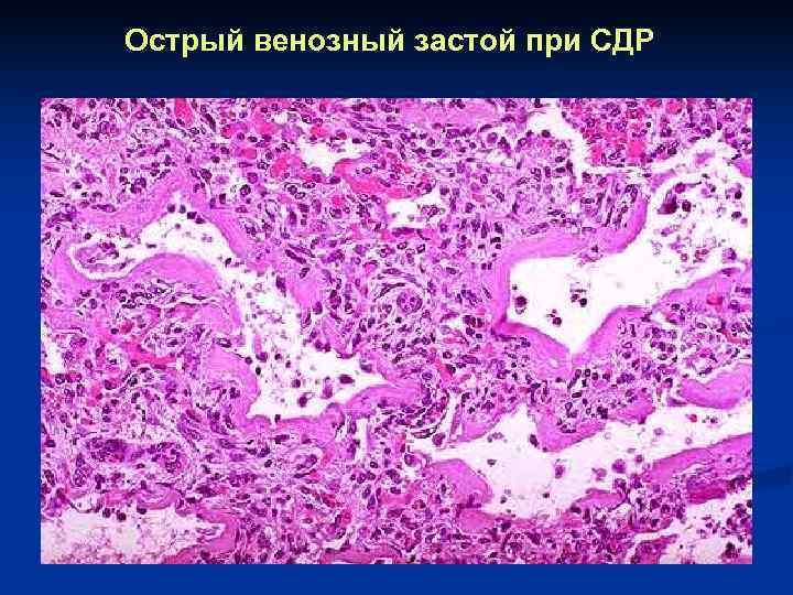 Острый венозный застой при СДР 