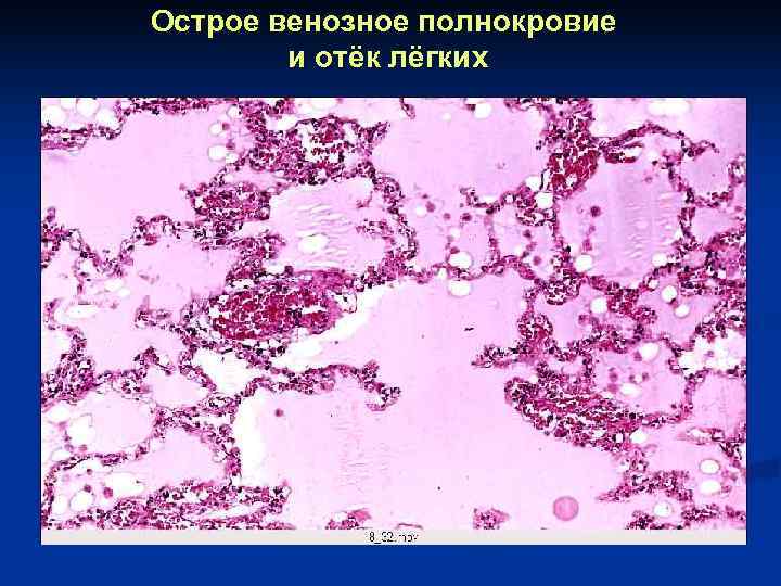 Острое венозное полнокровие   и отёк лёгких 