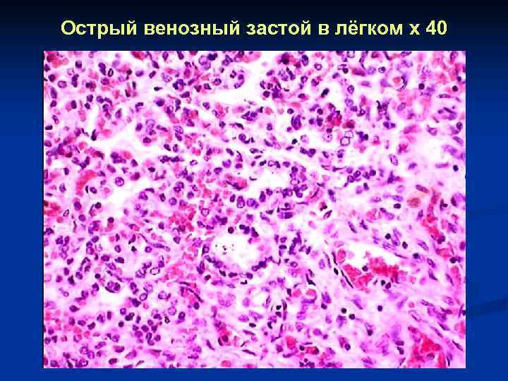 Острый венозный застой в лёгком x 40 