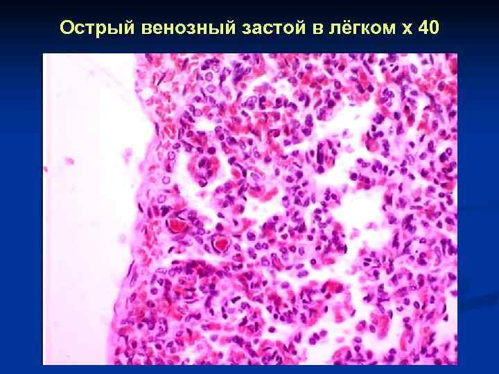 Острый венозный застой в лёгком x 40 