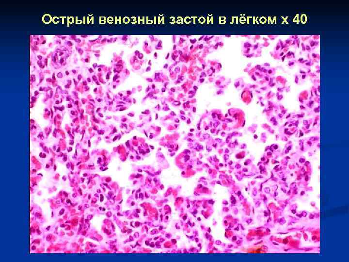 Острый венозный застой в лёгком x 40 