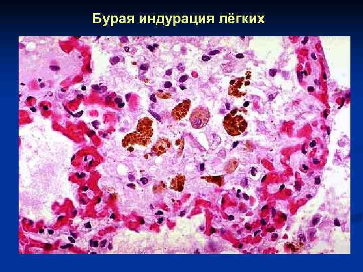 Бурая индурация лёгких 