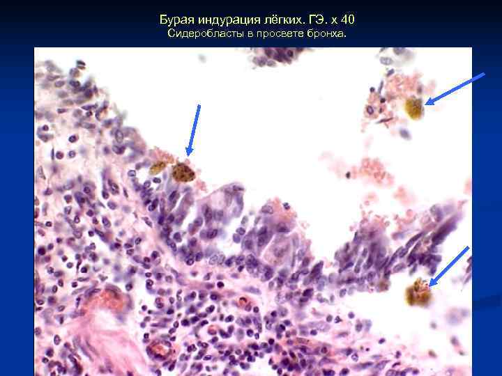 Бурая индурация лёгких. ГЭ. х 40 Сидеробласты в просвете бронха. 