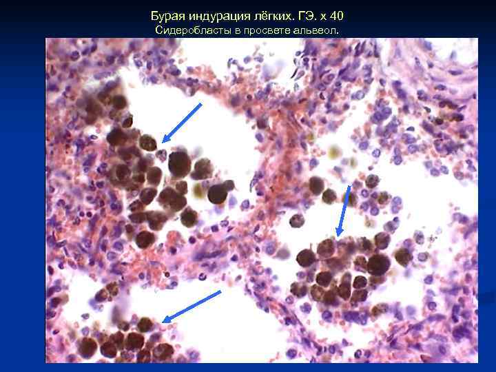 Бурая индурация лёгких. ГЭ. х 40 Сидеробласты в просвете альвеол. 
