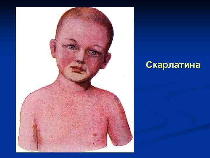 Скарлатина 