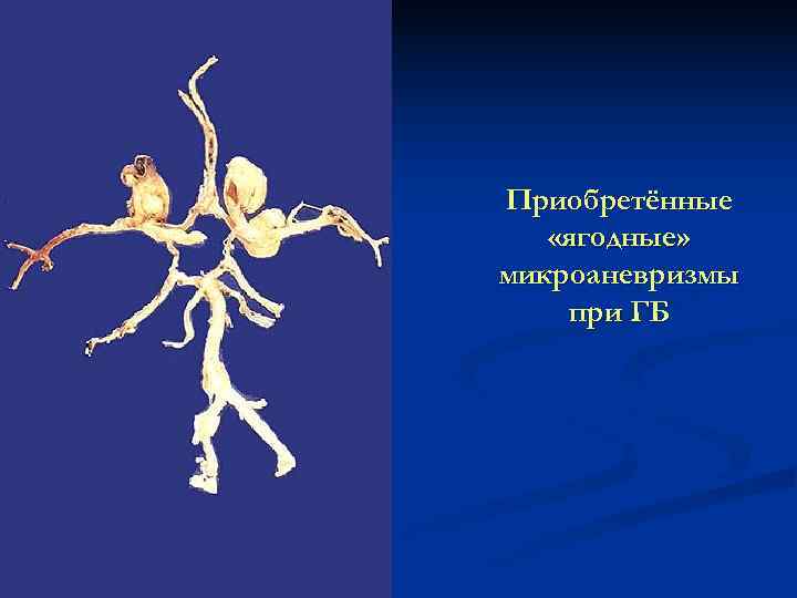 Приобретённые «ягодные» микроаневризмы при ГБ 