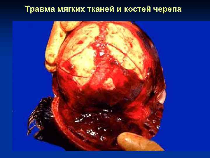 Травма мягких тканей и костей черепа 