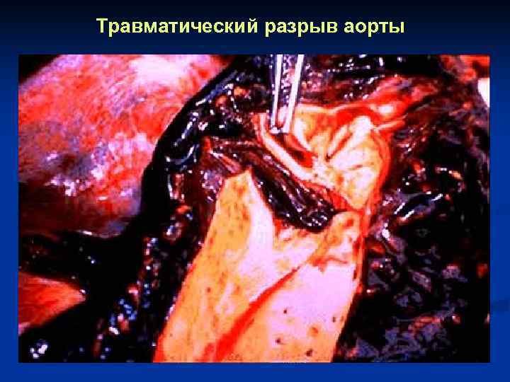 Травматический разрыв аорты 