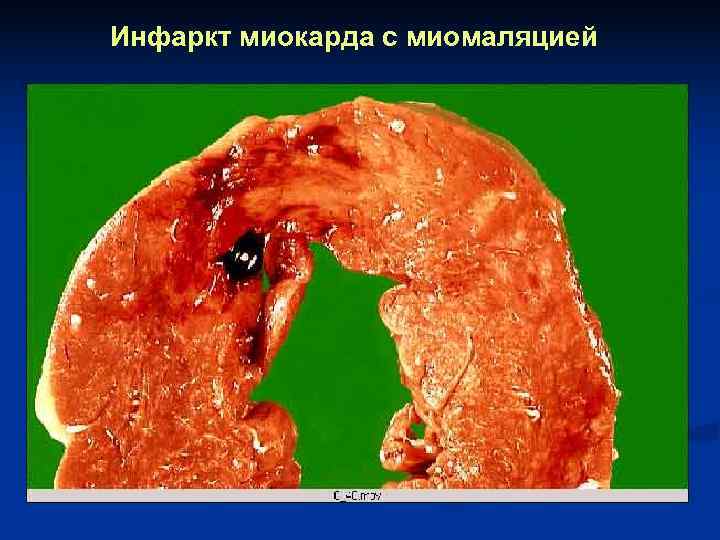 Инфаркт миокарда с миомаляцией 