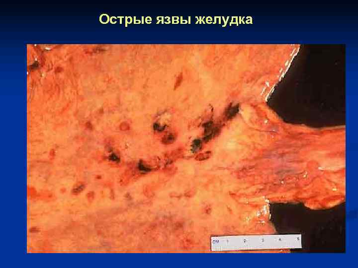Острые язвы желудка 