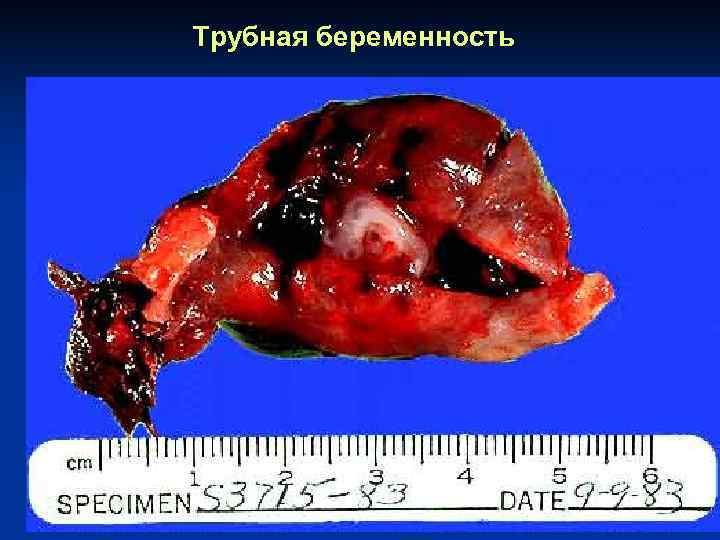 Трубная беременность 