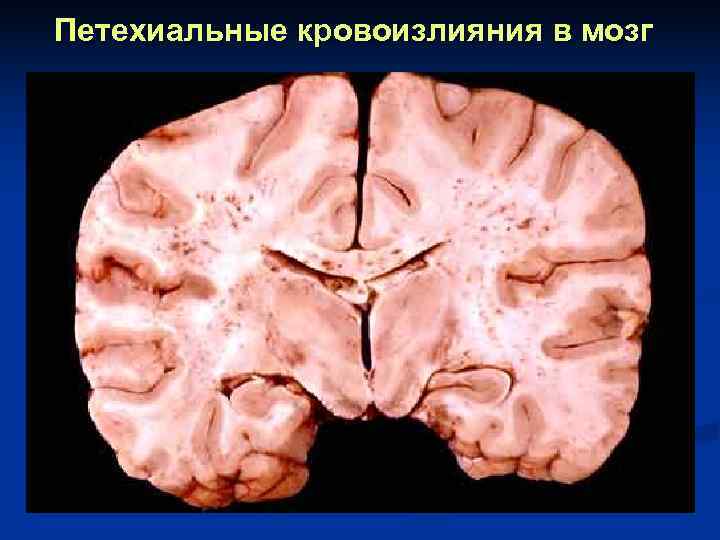 Петехиальные кровоизлияния в мозг 
