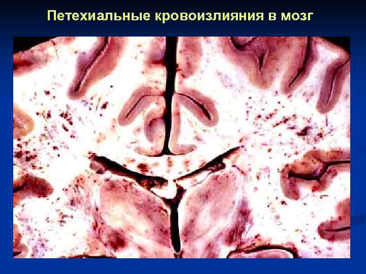 Петехиальные кровоизлияния в мозг 