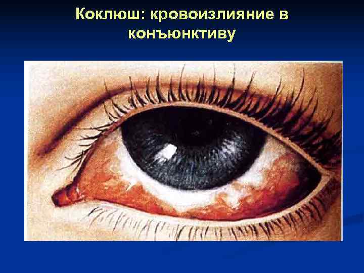 Коклюш: кровоизлияние в конъюнктиву 