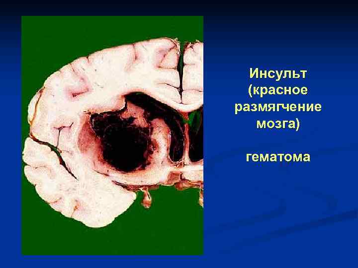 Размягчение стула при геморрое