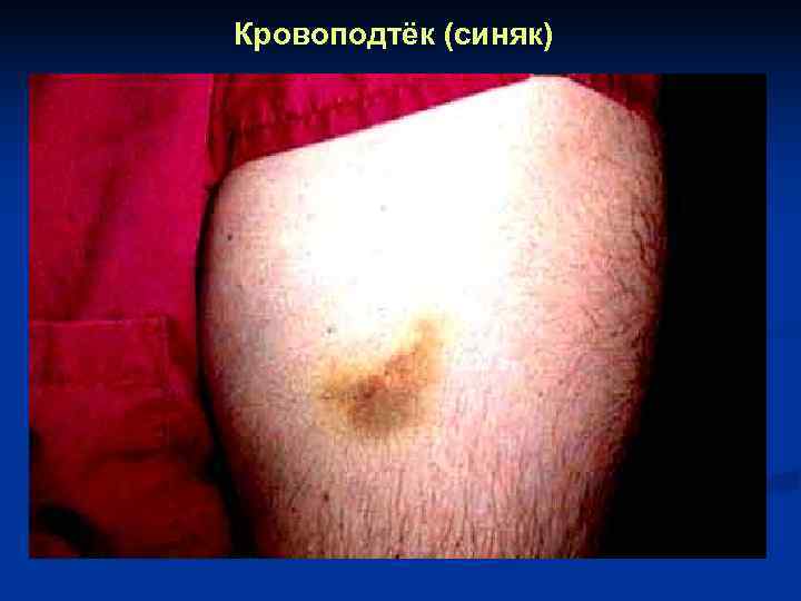 Кровоподтёк (синяк) 