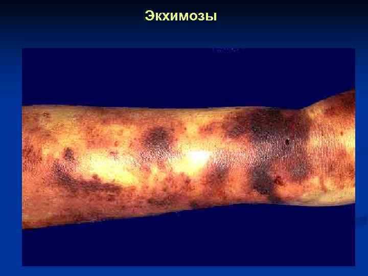 Экхимозы 