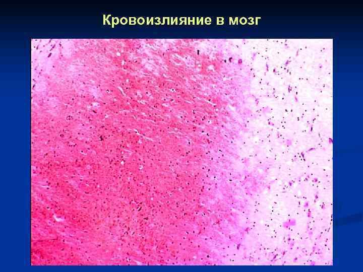 Кровоизлияние в мозг 