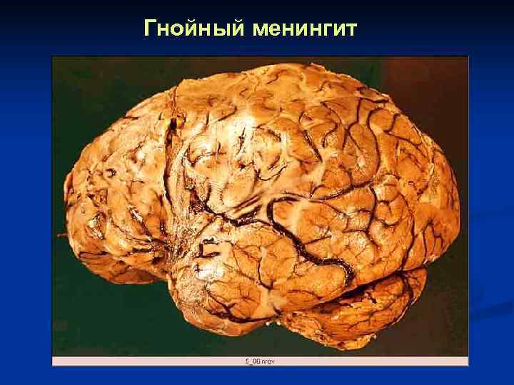 Гнойный менингит 