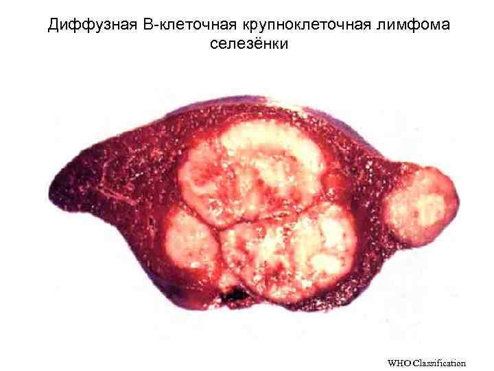 Диффузная В-клеточная крупноклеточная лимфома    селезёнки    WHO Classification 