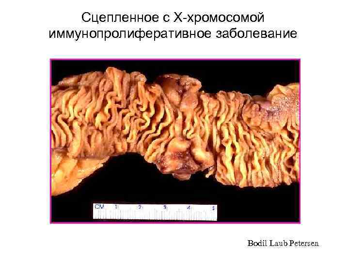   Сцепленное с Х-хромосомой иммунопролиферативное заболевание      Bodil Laub