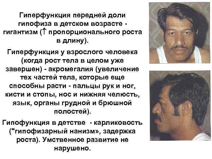 Гиперфункция передней доли гипофиза в детском возрасте гигантизм ( пропорционального роста в длину). Гиперфункция