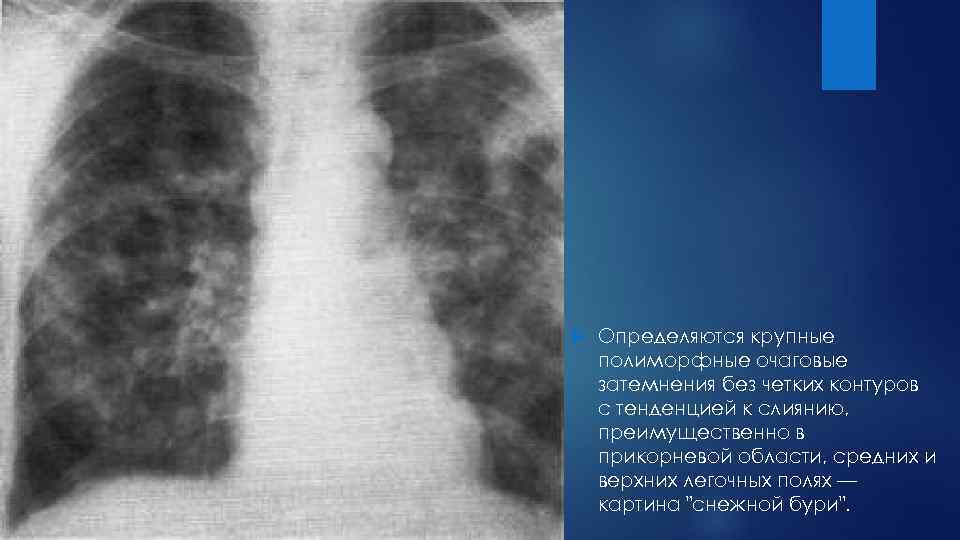 Рентген картина туберкулеза легких