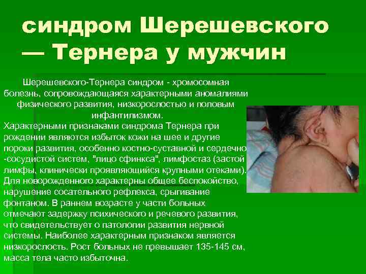 синдром Шерешевского — Тернера у мужчин Шерешевского-Тернера синдром - хромосомная болезнь, сопровождающаяся характерными аномалиями