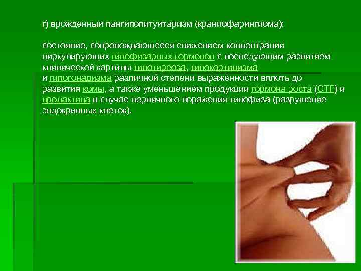 г) врожденный пангипопитуитаризм (краниофарингиома); состояние, сопровождающееся снижением концентрации циркулирующих гипофизарных гормонов с последующим развитием