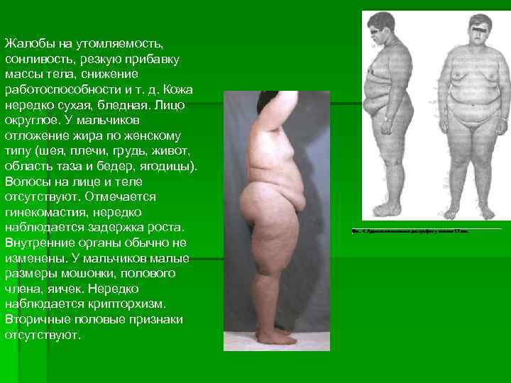 Жалобы на утомляемость, сонливость, резкую прибавку массы тела, снижение работоспособности и т. д. Кожа