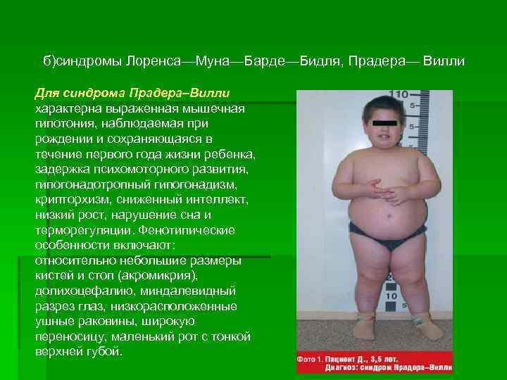 б)синдромы Лоренса—Муна—Барде—Бидля, Прадера— Вилли Для синдрома Прадера–Вилли характерна выраженная мышечная гипотония, наблюдаемая при рождении