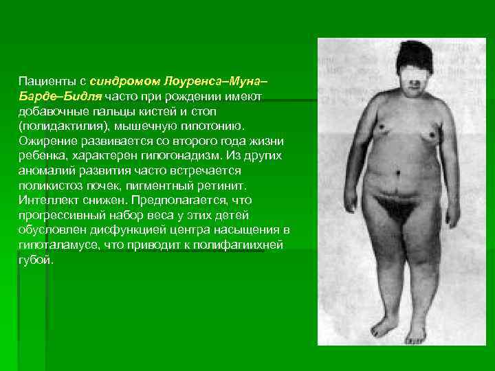 Пациенты с синдромом Лоуренса–Муна– Барде–Бидля часто при рождении имеют добавочные пальцы кистей и стоп