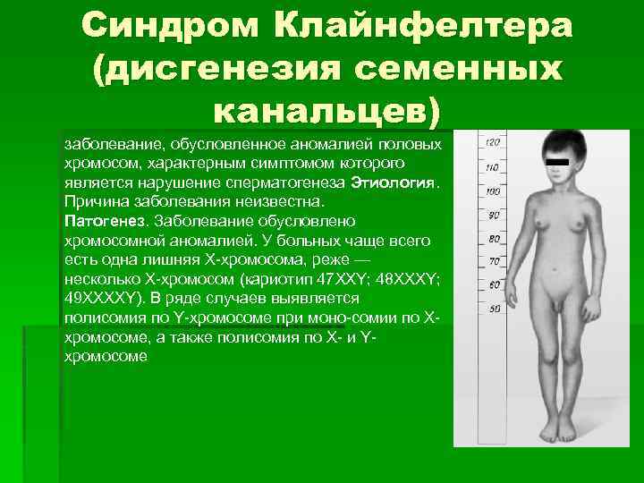 Синдром Клайнфелтера (дисгенезия семенных канальцев) заболевание, обусловленное аномалией половых хромосом, характерным симптомом которого является