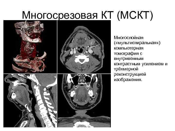 Кт скрининг коронарного кальция