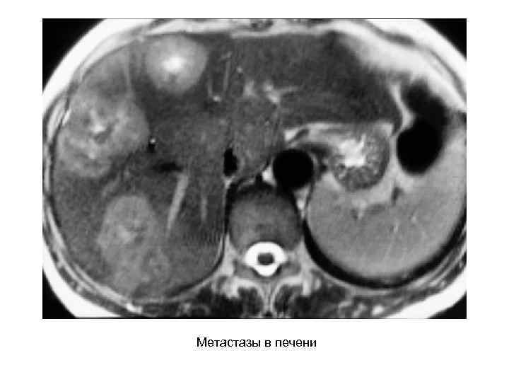 Как выглядят метастазы в печени на кт с контрастом фото