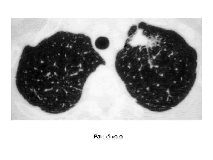 Рак лёгкого 