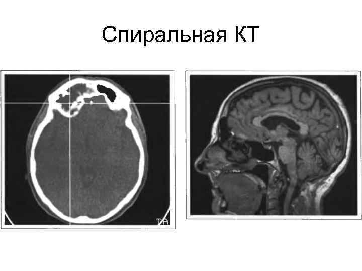 Спиральная КТ 