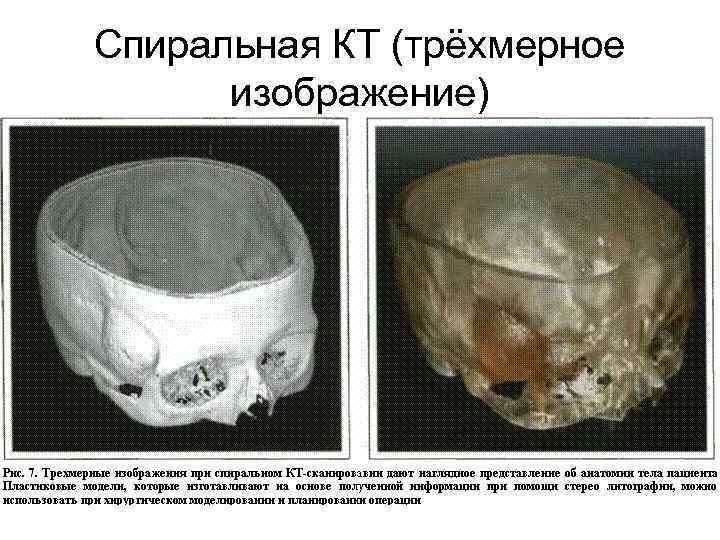 Спиральная КТ (трёхмерное изображение) 