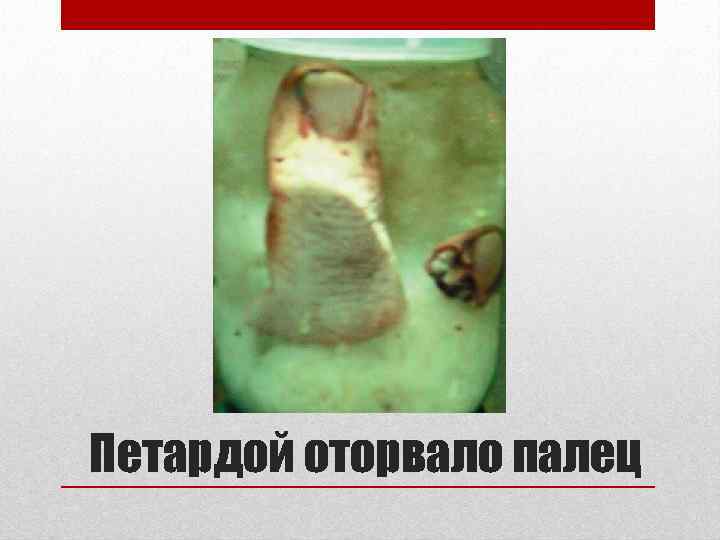 Петардой оторвало палец 