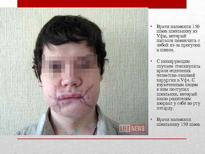  • Врачи наложили 150  швов школьнику из  Уфы, который  пытался