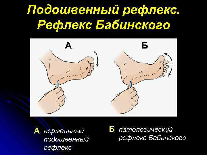 Подошвенный рефлекс. Рефлекс Бабинского А А нормальный подошвенный рефлекс Б Б патологический рефлекс Бабинского